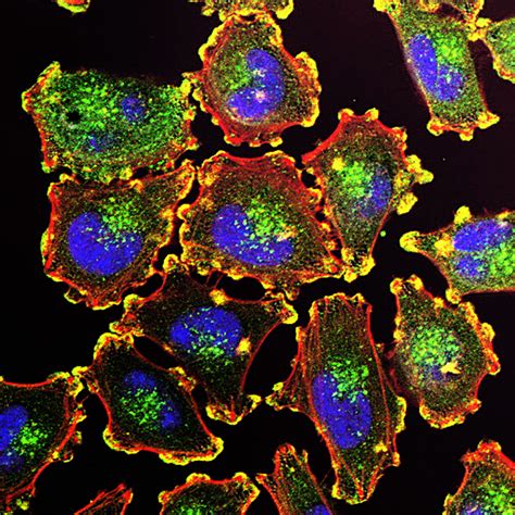 Custom cancer vaccines safely fight and kill tumors in early human trials | Ars Technica