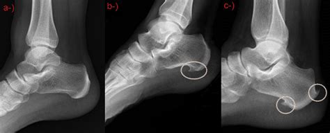 a-No spur, b-Only plantar calcaneal spur, c-Plantar calcaneal spur and... | Download Scientific ...