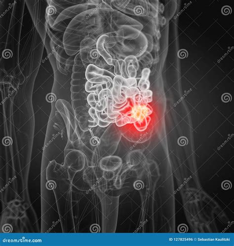 Small intestine cancer stock illustration. Illustration of bowel ...