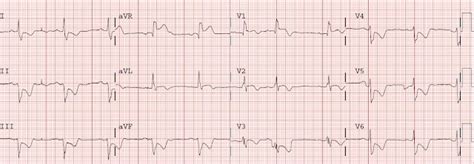 Dr. Smith's ECG Blog: Beware crescendo angina in patient with known CAD