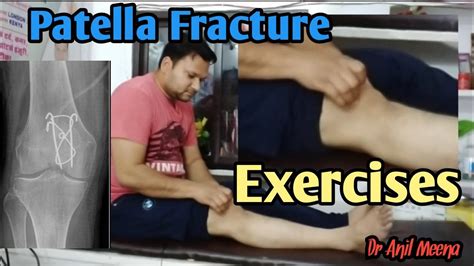 Patella Fracture Recovery Exercises | Patella Fracture Exercises ...