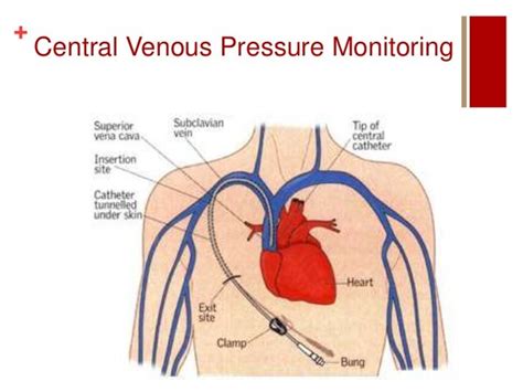 Central Venous Pressure; Venous Pressure, Central