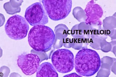 Acute Myeloid Leukemia | CheckRare