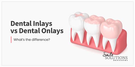 Dental Inlays vs Onlays // Smile Solutions Family Dentistry