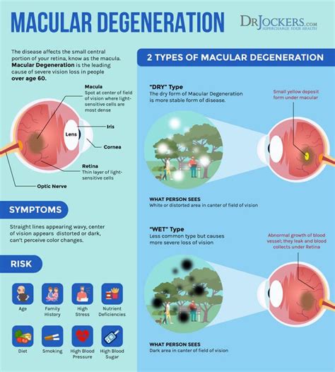 Macular Degeneration: Causes, Symptoms & Solutions in 2020 | Macular ...