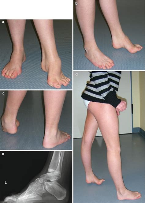 Surgical Treatment of Cavus Foot Deformity | SpringerLink