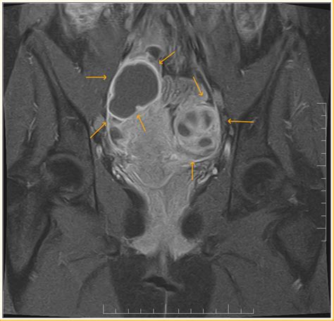 Adnexal Masses: MRI evaluation - Sumer's Radiology Blog