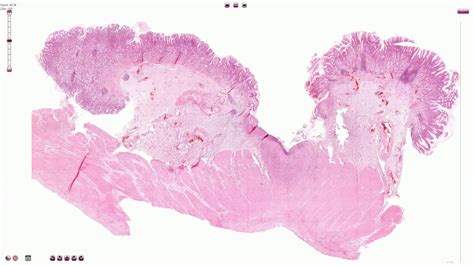 Gastric Ulcer Histology