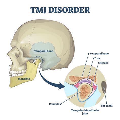 Your Guide To TMJ Disorder | Encino & San Fernando Valley, CA