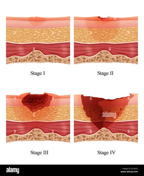 Bed Sores Pressure Ulcer Causes Stages Prevention Pressure Ulcer ...