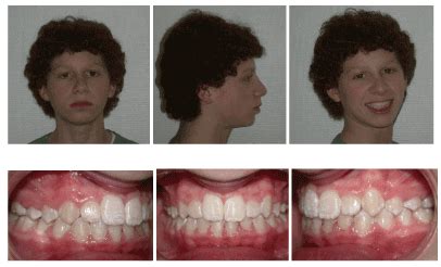 Functional treatment of maxillary hypoplasia and mandibular prognathism