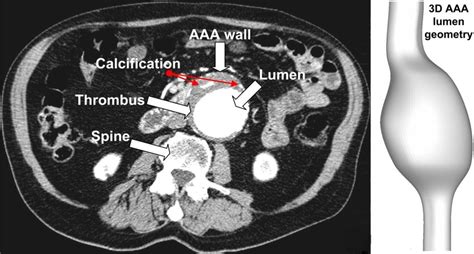 Automated AAA detection on CT scans - Diagnostic Image Analysis Group