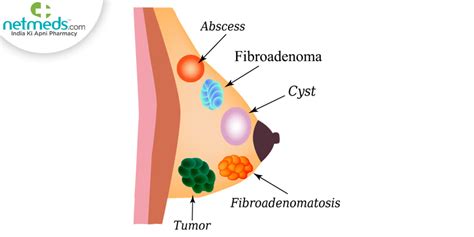 Fibroadenoma: Causes, Symptoms and Treatment