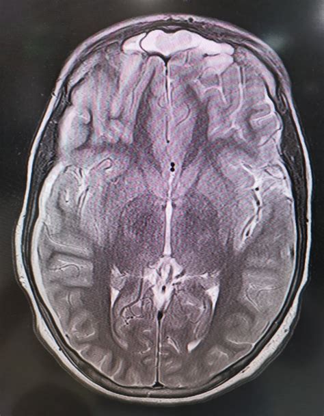 MRI brain with contrast at the next morning: Mild diffuse thickening of... | Download Scientific ...