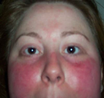 Malar Rash (Butterfly Rash) - Pictures, Causes, Diagnosis and Treatment