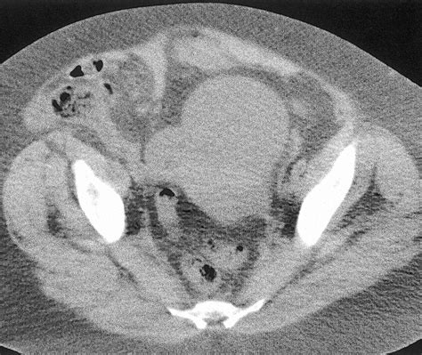 Open vs Laparoscopic Repair of Spigelian Hernia: A Prospective Randomized Trial | Surgery | JAMA ...