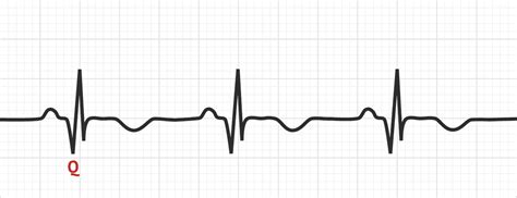 Pathological Q Waves | Test Findings - MedSchool