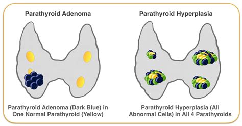 Parathyroid Adenoma and Hyperplasia Graphic - Hyperparathyroidism Surgery - Dr. Babak Larian