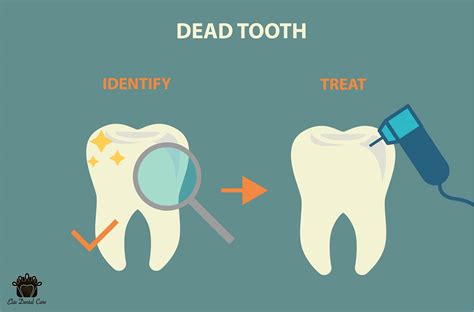 Identifying and Treating a Dead Tooth - Elite Dental Care Tracy | Elite Dental Care