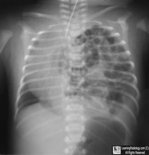 Scaphoid Abdomen Diaphragmatic Hernia : A small diaphragmatic hernia is diagnosed by fluoroscopy ...