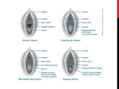 Benign tumours,cysts