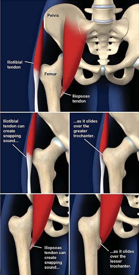 Snapping Hip Syndrome | Central Coast Orthopedic Medical Group