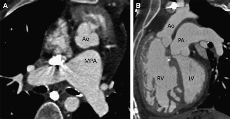 Dextro-transposition of the great arteries. (A) Axial CT image shows ...