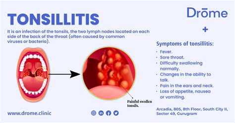 Tonsillitis: Causes, Symptoms, and Effective Treatments