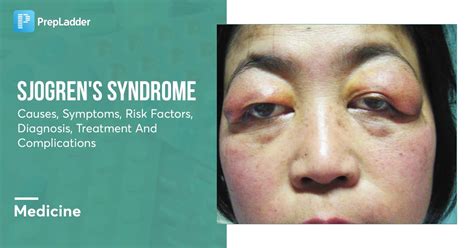 Sjogren's Syndrome: Causes, Symptoms, Risk Factors