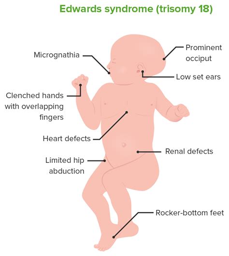 Síndrome de Edwards (Trissomia 18) | Concise Medical Knowledge