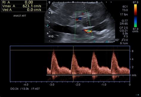 Buscar a tientas discreción Monótono renal artery duplex ultrasound Supone Prueba Carne de cordero