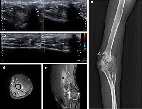 Radial nerve anatomy, radial nerve palsy and radial nerve injury