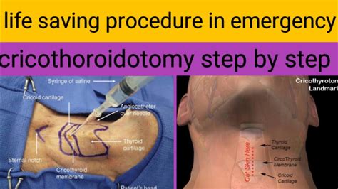 Emergency airway management l needle cricothyroidotomy l doctorsms # ...