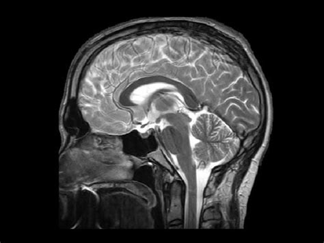 The Ventricles: Neuroanatomy Video Lab - Brain Dissections - YouTube