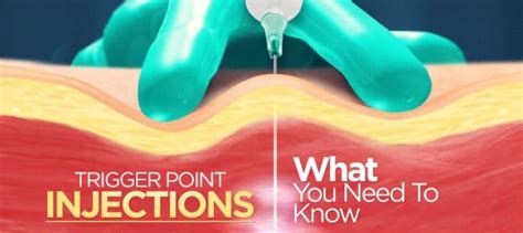 Trigger Point Injections: What You Need to Know - THE ORTHOHEALING CENTER