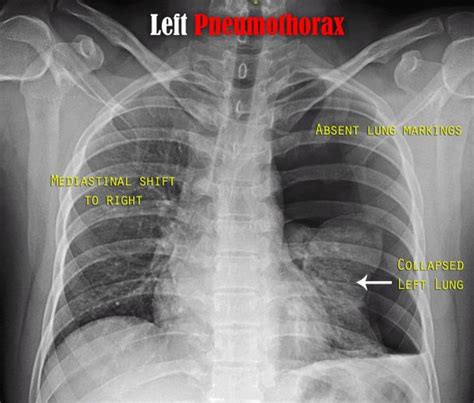 Pneumothorax in the Emergency Department - Part 1 - EMOttawa Blog