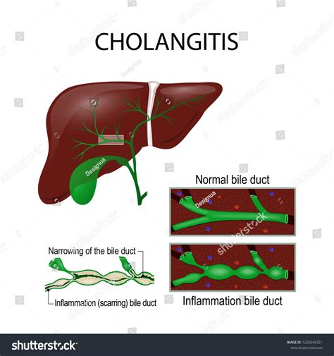 Cholangitis Ascending Cholangitis Acute Cholangitis Infection Stock ...