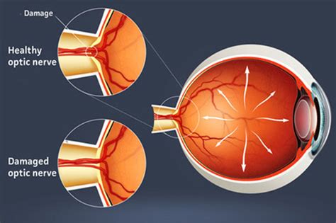 DAMAGED OPTIC NERVE: CAUSE OF GLAUCOMA - Vision SmartVision Smart