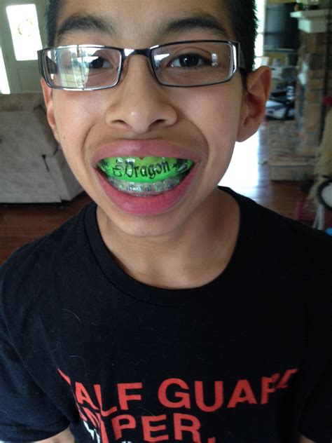 This the way we roll for braces! Notice guards on upper and lower teeth. Your sport may not ...