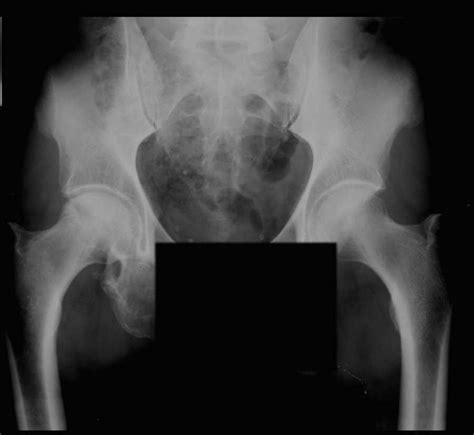 AVN Femoral Head on X-ray - X Rays Case Studies - CTisus CT Scanning