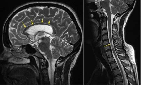 Multiple sclerosis - spinal cord atrophy - Radiology at St. Vincent's University Hospital