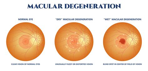 Macular Degeneration | South Carolina Retina Institute