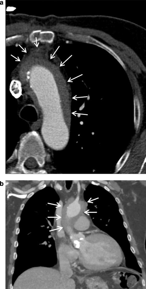 a and b) CT scan of ascending aorta and arch. White arrows mark the... | Download Scientific Diagram