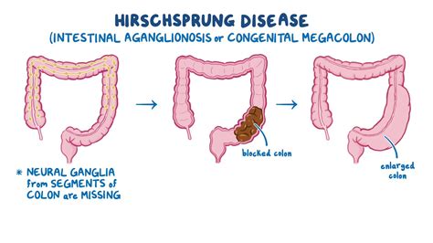 Hirschsprung disease: Nursing - Osmosis Video Library