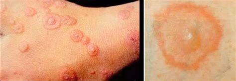 Erythema multiforme - Pictures, Treatment, Symptoms, Causes