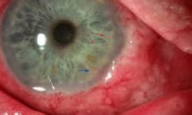 Cancer Compatibility: Eye Cancer Statistics and Prognosis