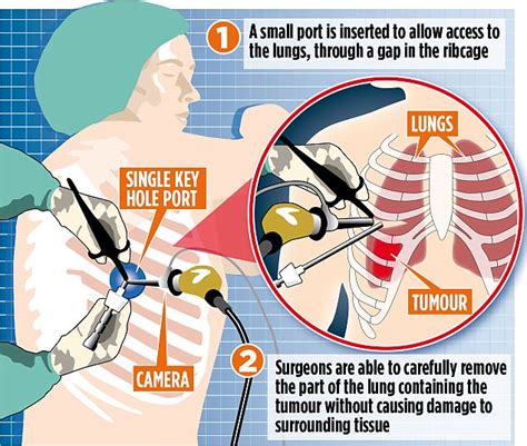 New lung cancer cure fixes patients in just four days | Daily Mail Online