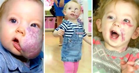 Adorable 2-Year-Old's Facial Tumor Removed in Amazing Transformation