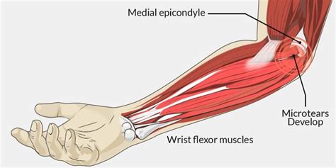 Suffering from Golfer's Elbow, are you? Then, Physiotherapy is your New Buddy! - Care2Cure ...