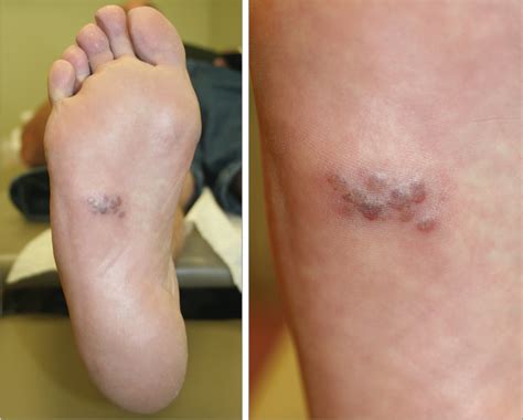 A 55-Year-Old Man With a Painful Rash on the Sole of His Foot | Dermatology | JAMA | JAMA Network